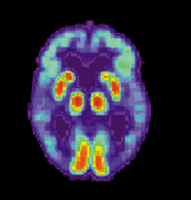 PET of Alzheimer A brain scan image with sections picked out in red and yellow and others in turquoise and dark blue